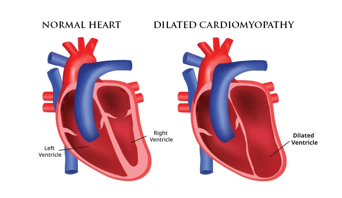Understanding Dilated Cardiomyopathy