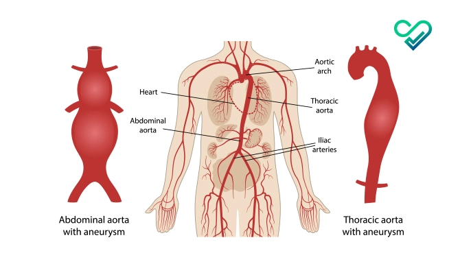 All About Thoracic Aortic Aneurysms