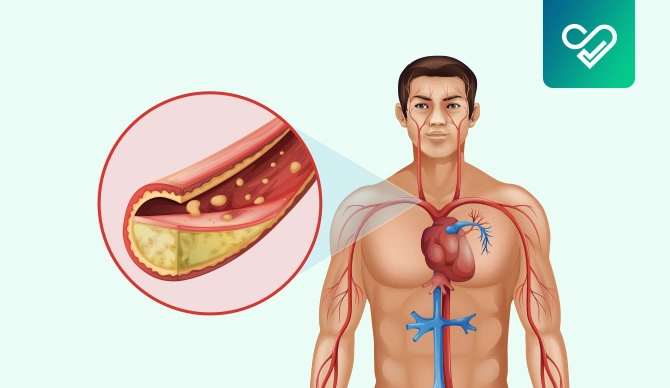 How To Clear Blocked Arteries Without Surgery